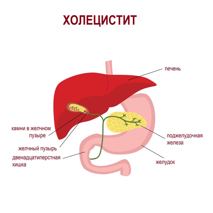 холецистит.jpg