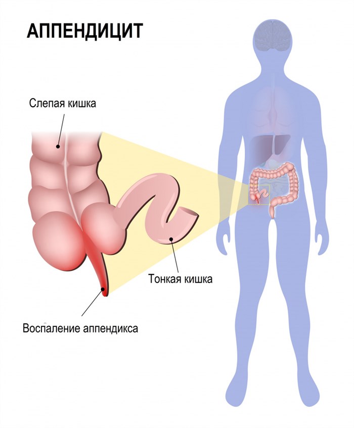 Аппендицит.jpg